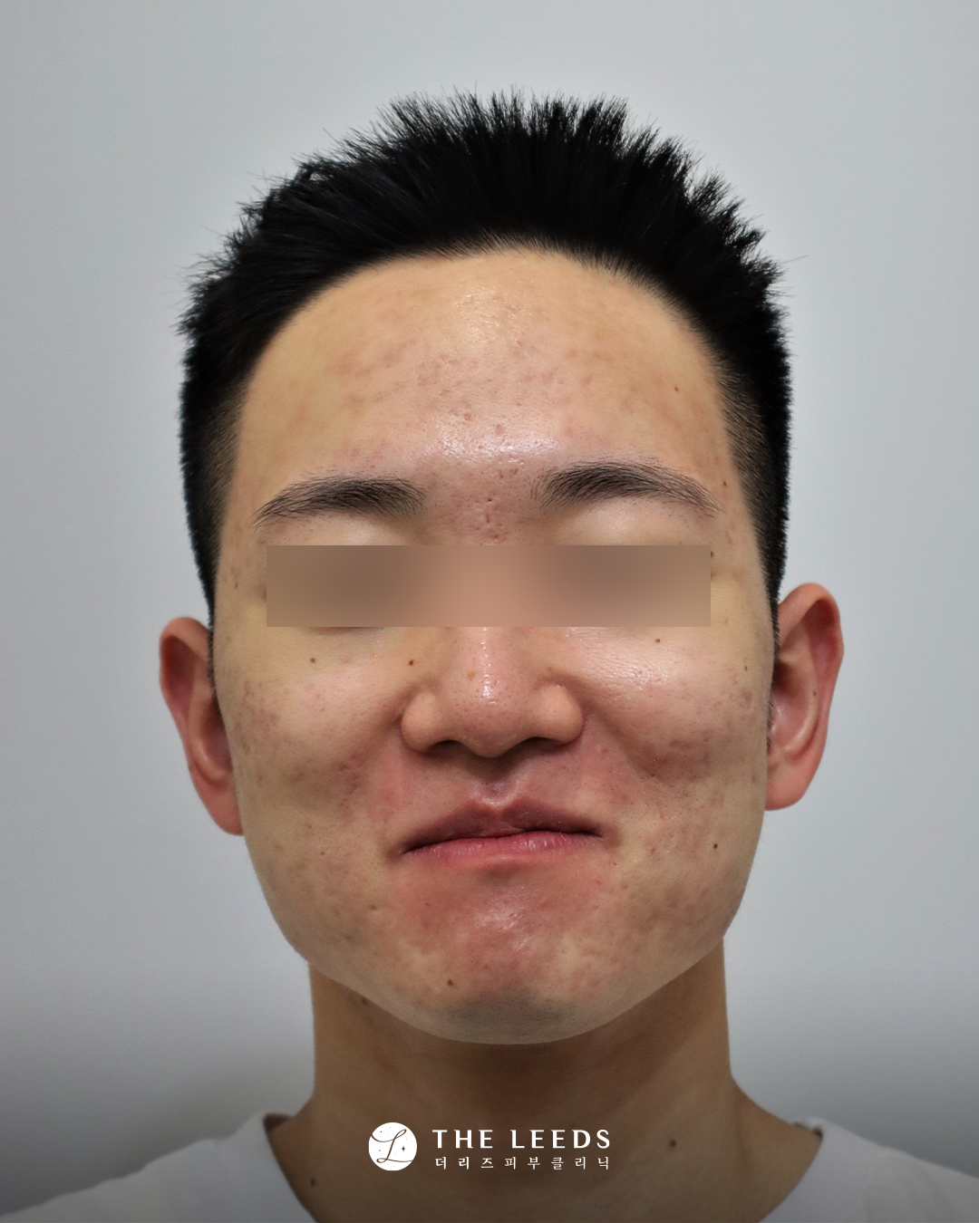 여드름